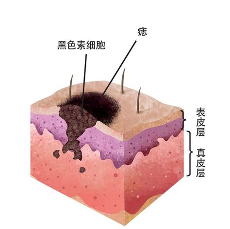 痣形成的原因